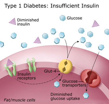 insulin-dependent diabetes